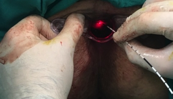 Περιεδρικό συρίγγιο-Θεραπεία με Laser