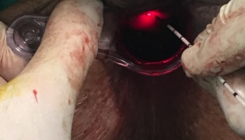 Περιεδρικό συρίγγιο-Θεραπεία με Laser