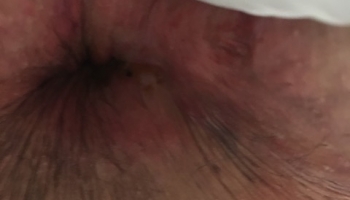 Περιεδρικό συρίγγιο-Θεραπεία με Laser