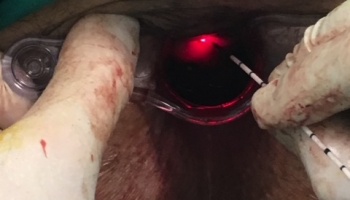 Περιεδρικό συρίγγιο-Θεραπεία με Laser