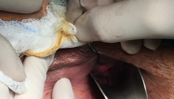 Περιεδρικό συρίγγιο-Θεραπεία με Laser