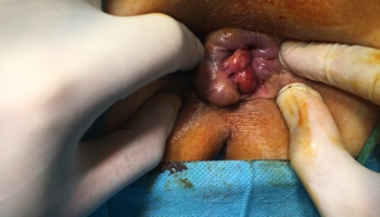 Αιμορροϊδοπάθεια 4ου βαθμού με πρόπτωση