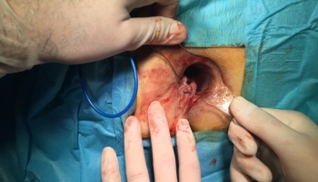 Αιμορροϊδοπάθεια 4ου βαθμού με πρόπτωση