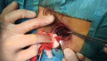 Αιμορροϊδοπάθεια 4ου βαθμού με πρόπτωση