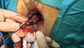 Αιμορροϊδοπάθεια 4ου βαθμού με πρόπτωση