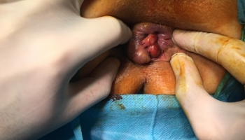 Αιμορροϊδοπάθεια 4ου βαθμού με πρόπτωση