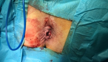 Αιμορροϊδοπάθεια 4ου βαθμού με πρόπτωση