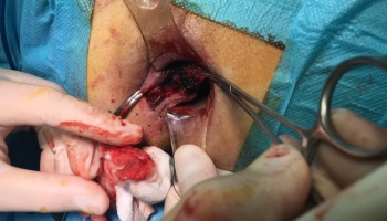 Αιμορροϊδοπάθεια 4ου βαθμού με πρόπτωση