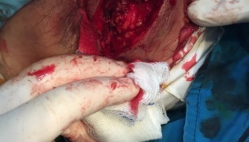 Περιεδρικό Απόστημα