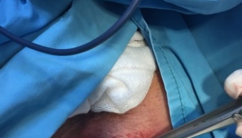 Περιεδρικό Απόστημα