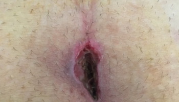 Περιεδρικό συρίγγιο