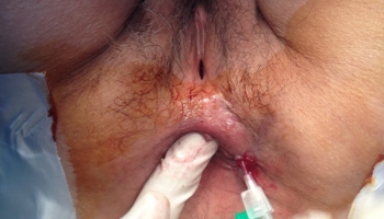 Περιεδρικό συρίγγιο