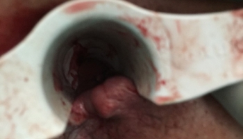 Θρόμβωση εξωτερικής αιμορροϊδας