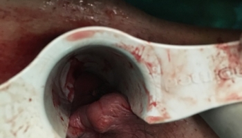 Θρόμβωση εξωτερικής αιμορροϊδας