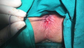 Περιεδρικό συρίγγιο με δύο έσω στόμια