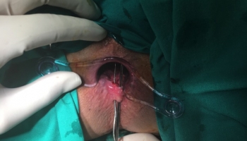 Περιεδρικό συρίγγιο με δύο έσω στόμια