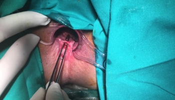 Περιεδρικό συρίγγιο με δύο έσω στόμια