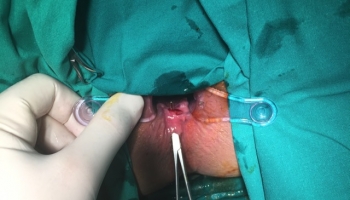 Περιεδρικό συρίγγιο με δύο έσω στόμια