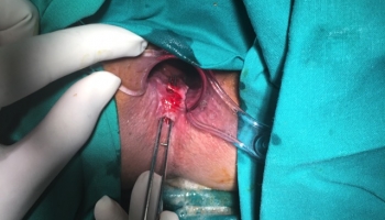 Περιεδρικό συρίγγιο με δύο έσω στόμια