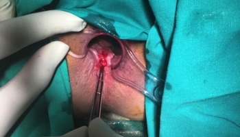 Περιεδρικό συρίγγιο με δύο έσω στόμια