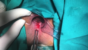 Περιεδρικό συρίγγιο με δύο έσω στόμια