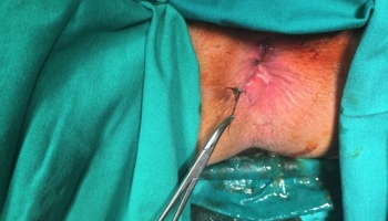 Περιεδρικό συρίγγιο με δύο έσω στόμια