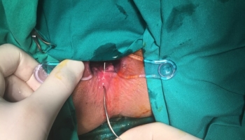 Περιεδρικό συρίγγιο με δύο έσω στόμια