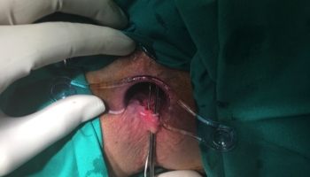 Περιεδρικό συρίγγιο με δύο έσω στόμια