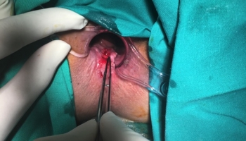 Περιεδρικό συρίγγιο με δύο έσω στόμια