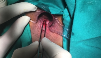 Περιεδρικό συρίγγιο με δύο έσω στόμια