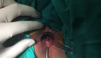 Περιεδρικό συρίγγιο με δύο έσω στόμια