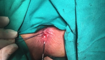 Περιεδρικό συρίγγιο με δύο έσω στόμια