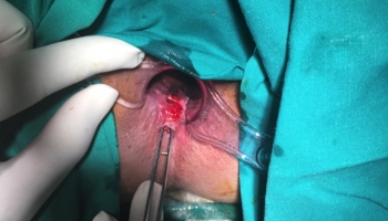 Περιεδρικό συρίγγιο με δύο έσω στόμια