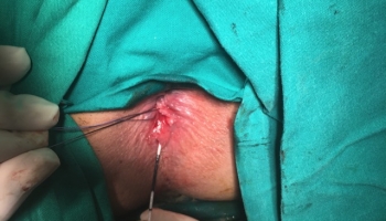 Διπλό περιεδρικό συρίγγιο