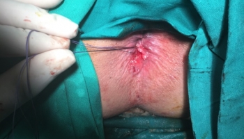 Περιεδρικό συρίγγιο με δύο έσω στόμια