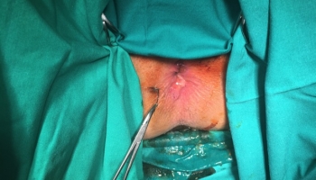 Περιεδρικό συρίγγιο με δύο έσω στόμια