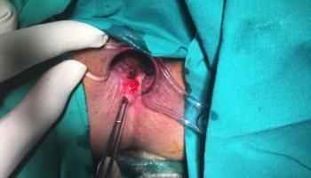 Περιεδρικό συρίγγιο με δύο έσω στόμια