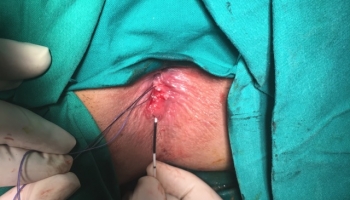 Περιεδρικό συρίγγιο με δύο έσω στόμια