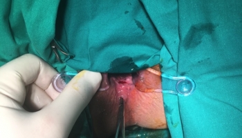 Περιεδρικό συρίγγιο με δύο έσω στόμια