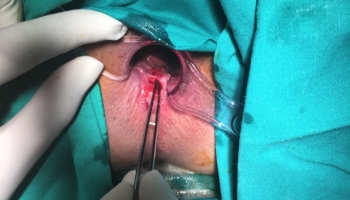 Περιεδρικό συρίγγιο με δύο έσω στόμια