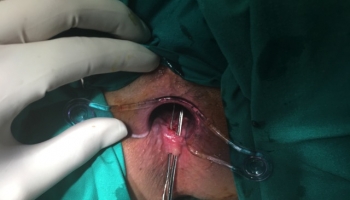 Περιεδρικό συρίγγιο με δύο έσω στόμια