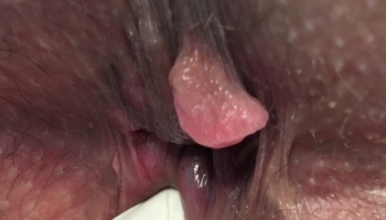 Ραγάδα πρωκτού με συνοδό αιμορροϊδα