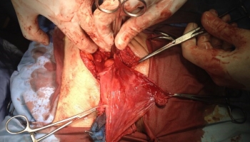 Υποτροπή βουβωνοκήλης