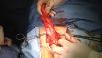 Υποτροπή βουβωνοκήλης