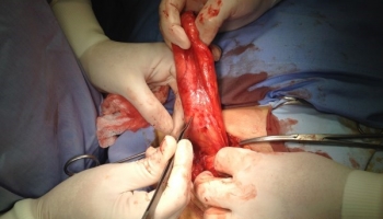 Υποτροπή βουβωνοκήλης