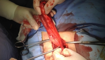 Υποτροπή βουβωνοκήλης