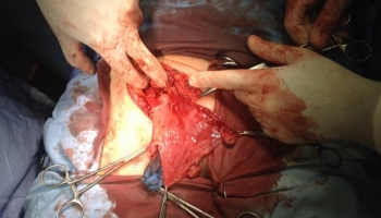 Υποτροπή βουβωνοκήλης