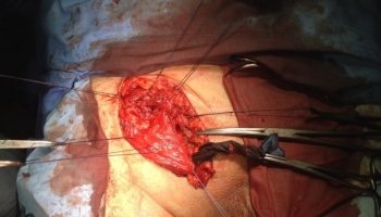 Υποτροπή βουβωνοκήλης