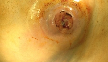  Κήλη παρα τη στομία