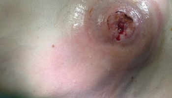  Κήλη παρα τη στομία